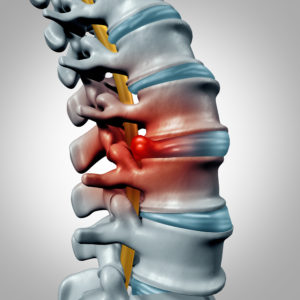 Herniated disk concept and spine pain diagnostic as a human spinal system symbol as medical health problem and anatomy symbol with the skeletal bone structure and intervertebral discs closeup.