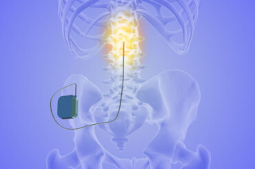 Spinal Cord Stimulation