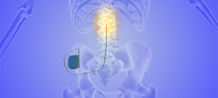 Spinal Cord Stimulation