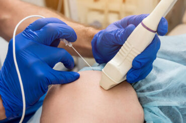 Radiofrequency Nerve Ablation