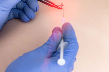 Trigger Point Injections