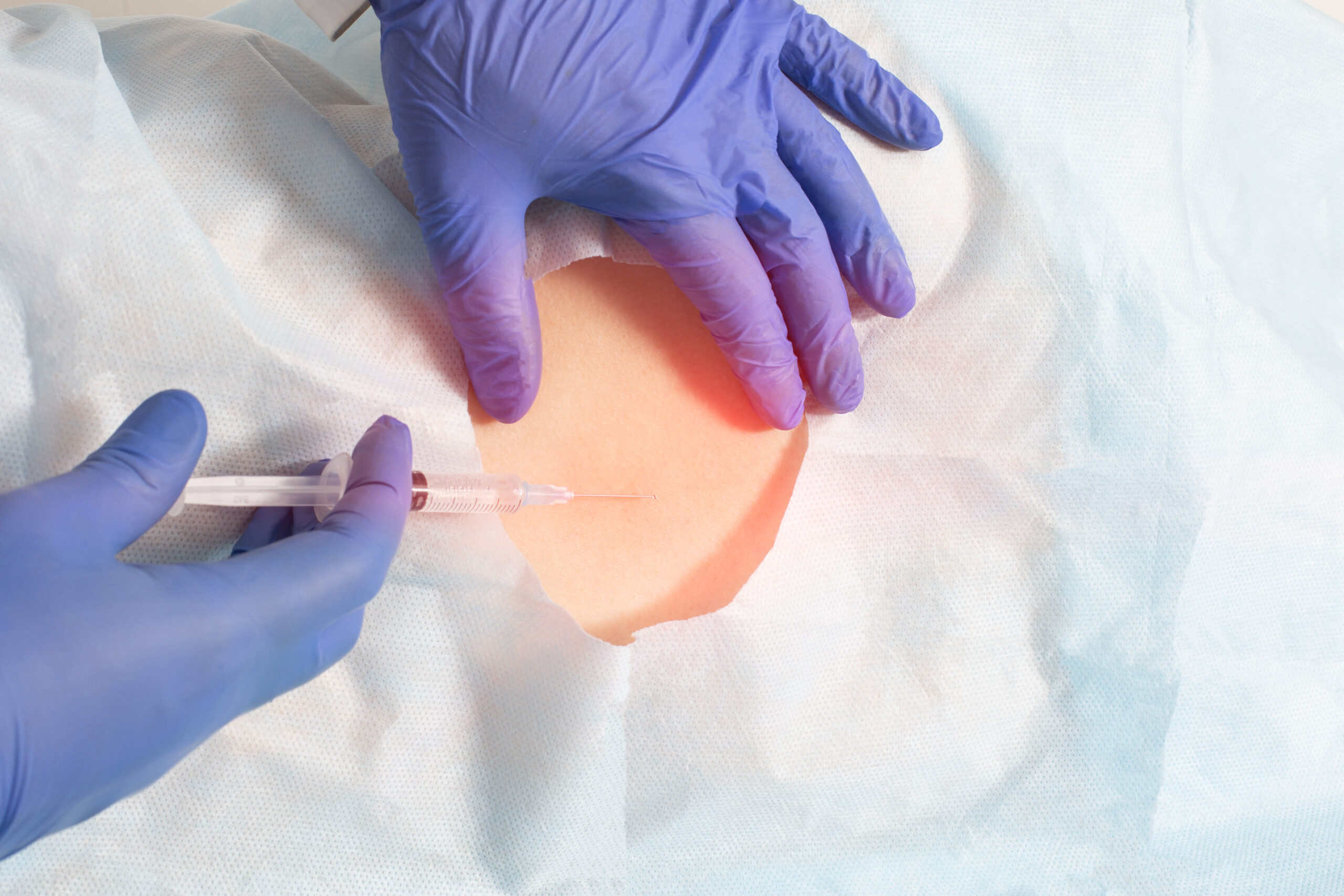 Epidural Steroid Injection